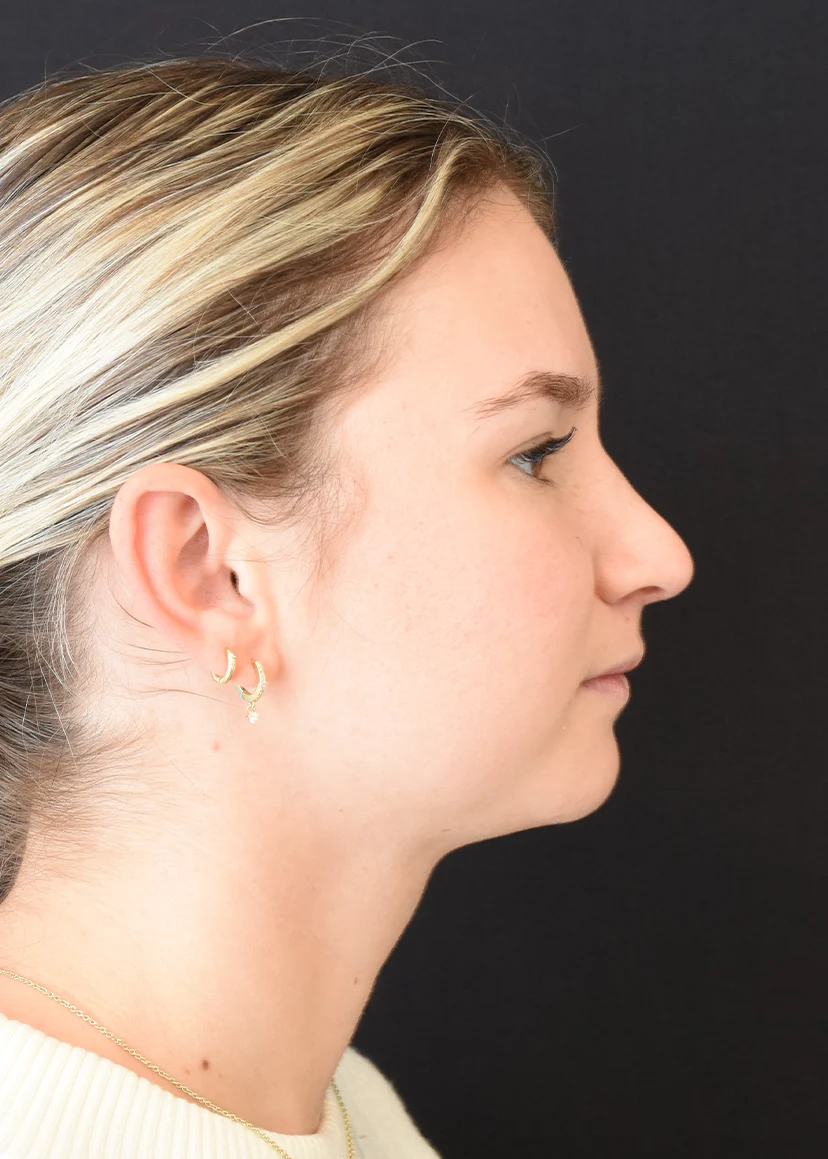 Rhinoplasty Patient 7 Set 3 After