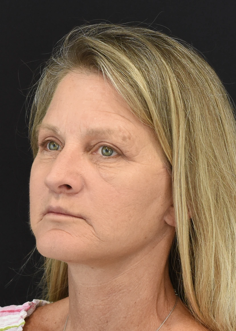 Deep Plane Facelift Patient 34 Set 1 After